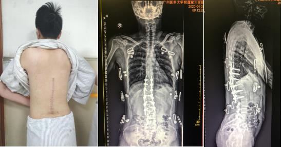 男子成年后奇迹般长高20cm，骨龄仅13到15岁男生骨龄15岁还能长10cm不